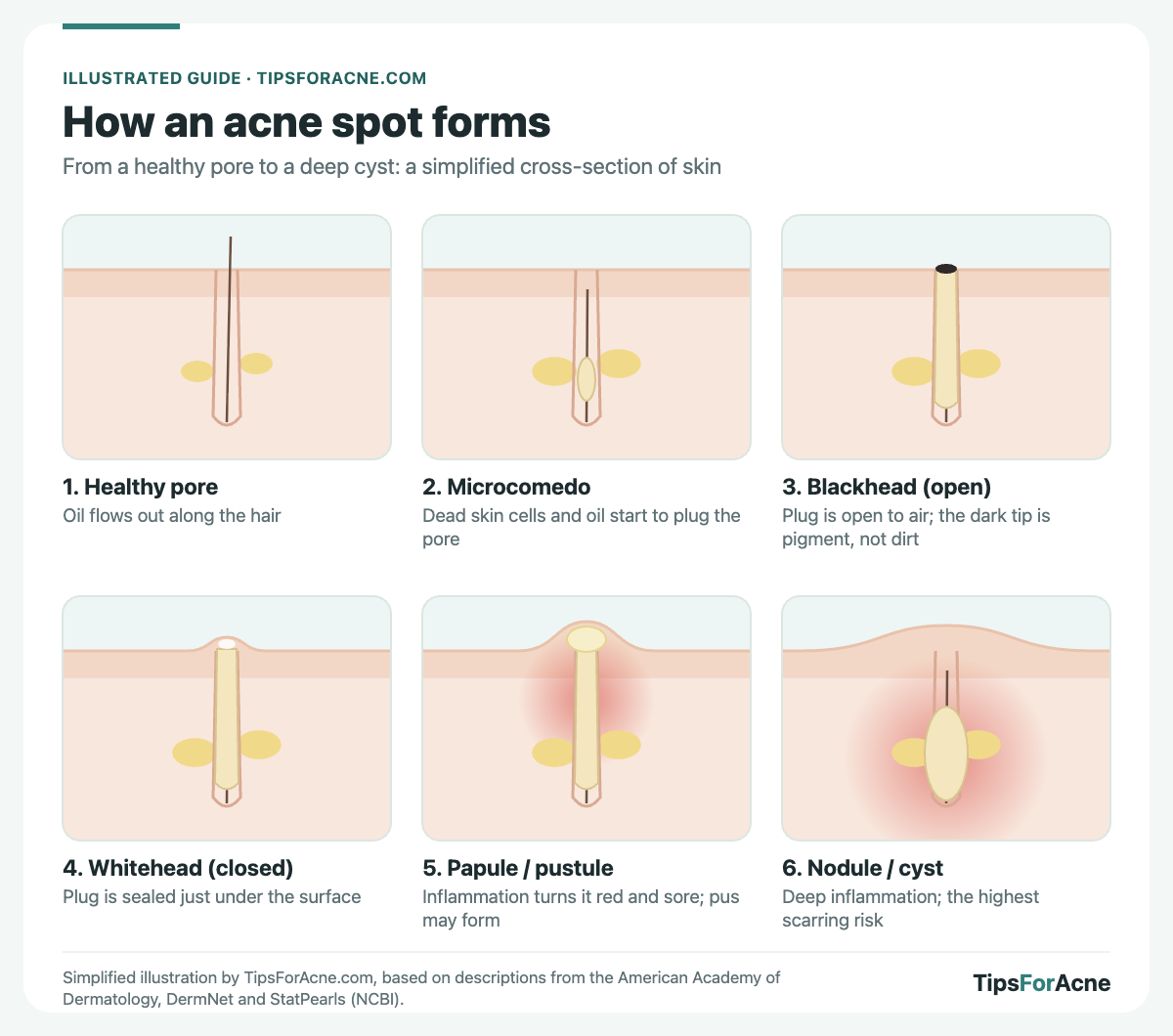 Diagram: how an acne spot forms, from a healthy pore to a microcomedo, blackhead, whitehead, papule or pustule, and nodule or cyst